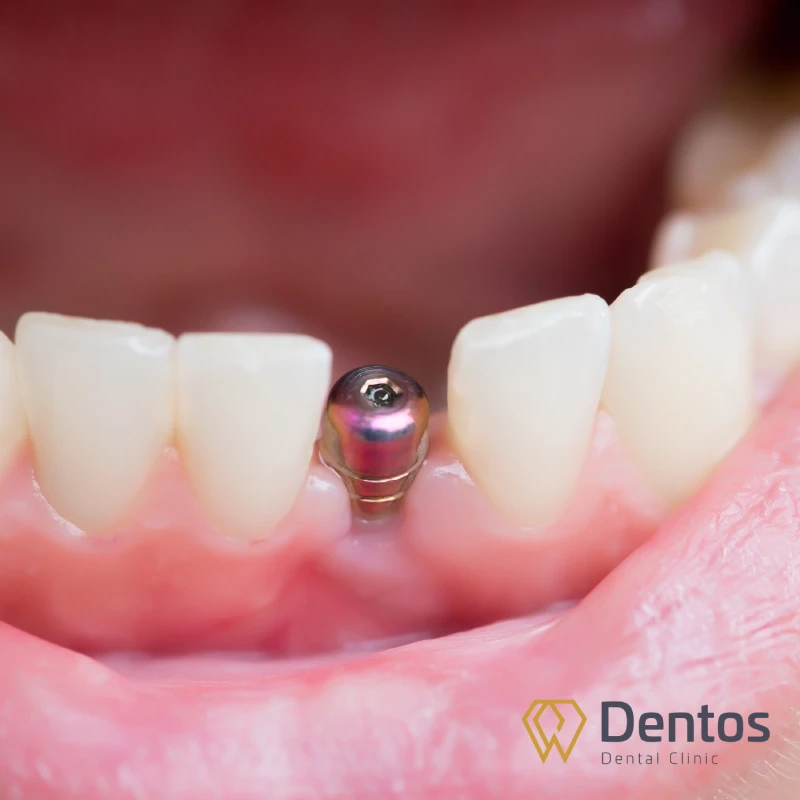 Khớp nối Abutment như một cùi răng đã được mài chỉnh trong kỹ thuật bọc răng sứ